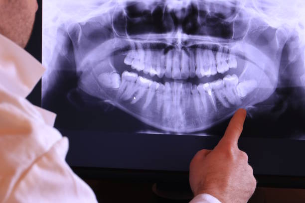 Best Emergency Tooth Extraction in Coldwater, OH